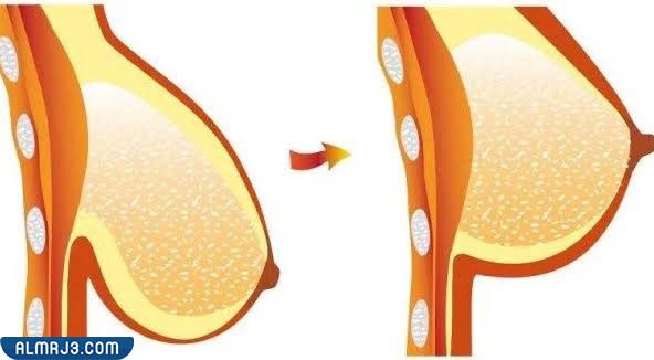 أهم اسباب تدلي الثديين أو ارتخاءهما