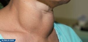 ضخامة غدة درقية