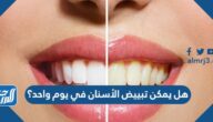 هل يمكن تبييض الأسنان في يوم واحد ؟