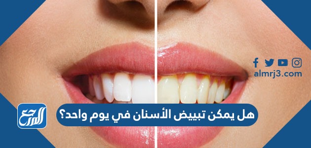 هل يمكن تبييض الأسنان في يوم واحد ؟