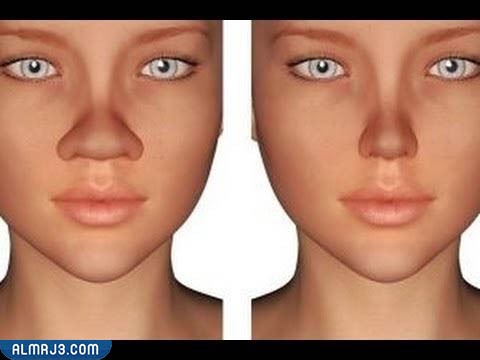 تجربتي مع تصغير الانف بالزنجبيل