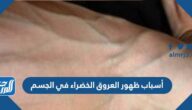 أسباب ظهور العروق الخضراء في الجسم
