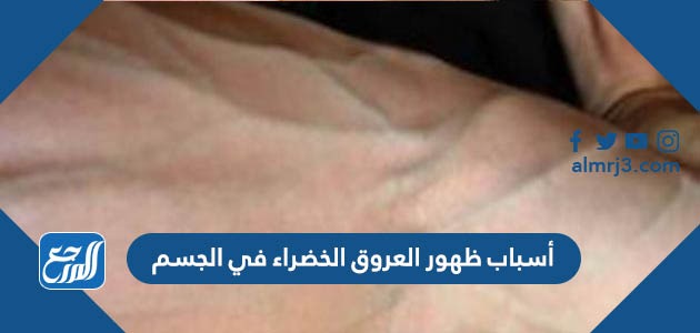 أسباب ظهور العروق الخضراء في الجسم