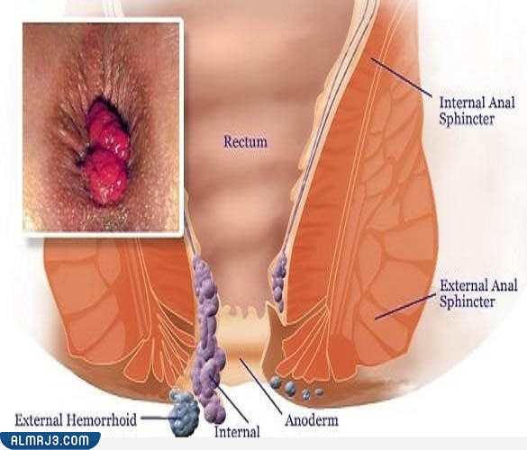  أعراض البواسير الخارجية وتطورات هذه الأعراض إذا أهمل المريض علاجها