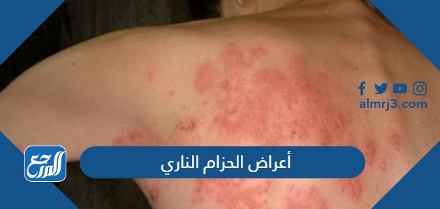 أعراض الحزام الناري