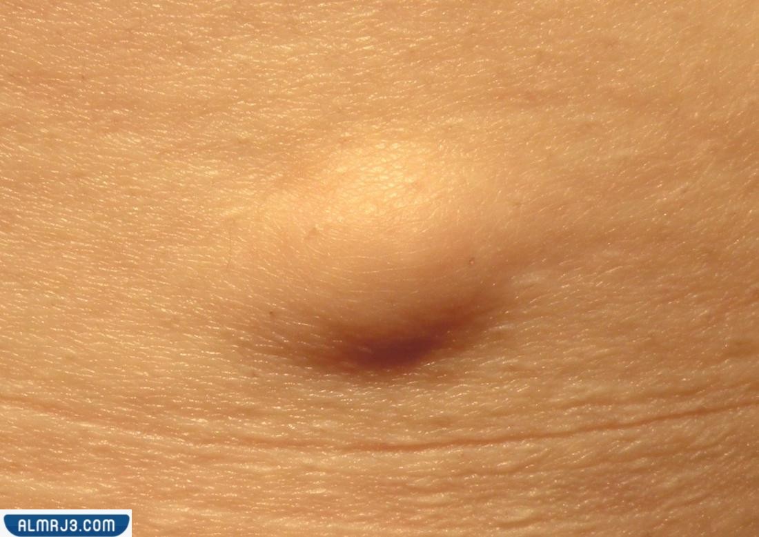 أعراض الورم الدهني