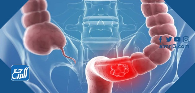 ألام القولون العصبي