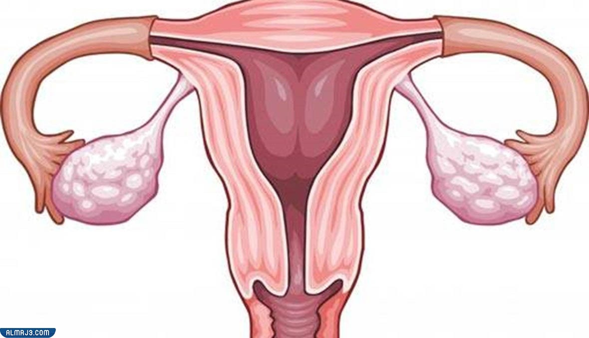 أنواع أكياس المبيض