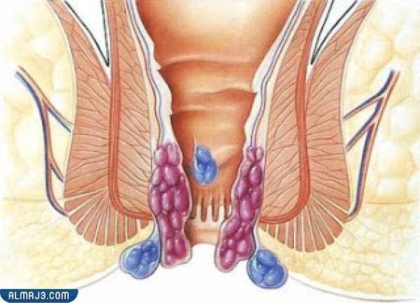 أنواع البواسير