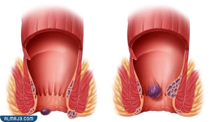 أنواع الشرخ الشرجي