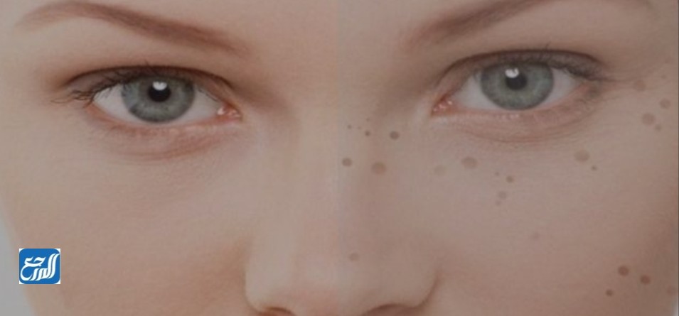 إزالة البقع السوداء