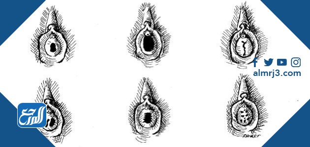 اشكال غشاء البكارة