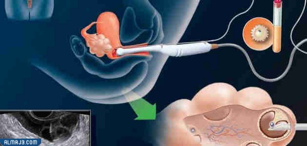 اطفال الانابيب