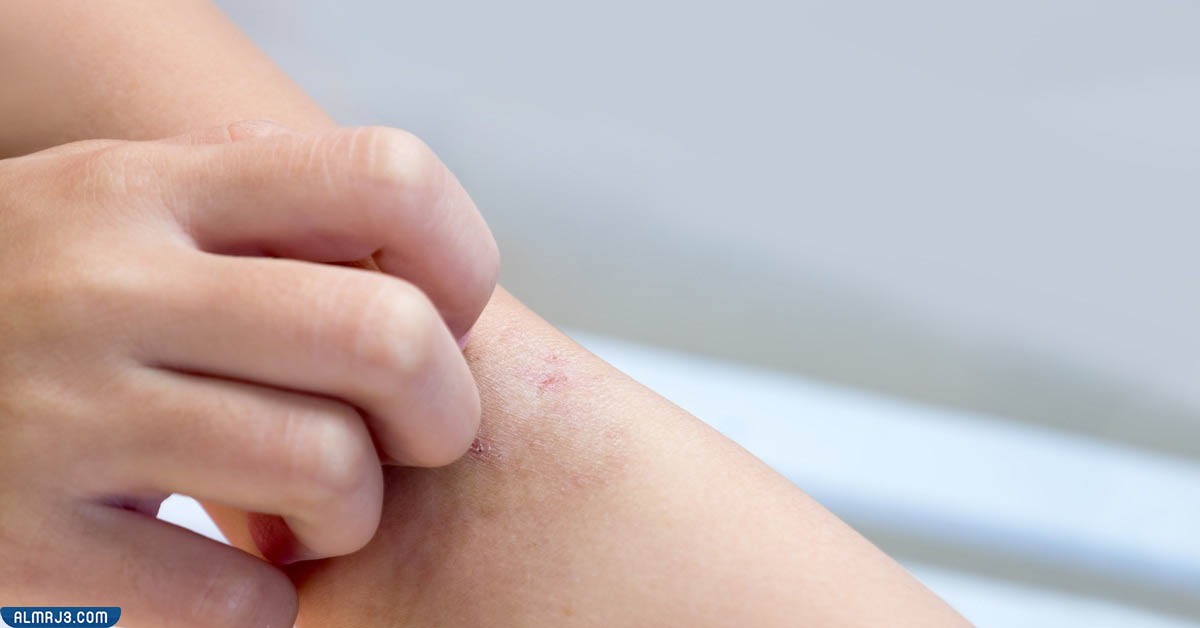 اعراض الجرب والحساسية