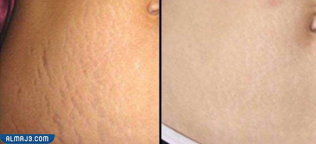 التجربة الأولى إزالة الخطوط البيضاء عن طريق استخدام الليزر