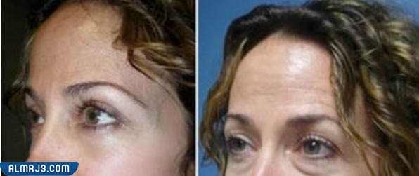 التجربة الأولى تجربة التخلص من ترهلات الجفون بالجراحة