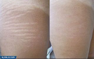 التجربة الثانية إزالة الخطوط البيضاء عن طريق الجراحات التجميلية