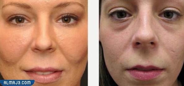 التجربة الثانية تجربة التخلص من ترهلات الجفون بالفيلر