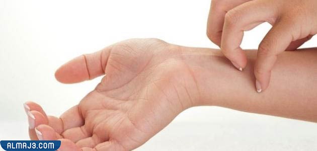 الفرق بين الجرب والحساسية