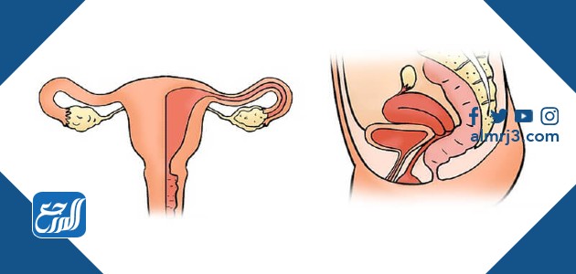 التهابات الرحم