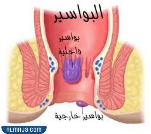 الفرق بين البواسير وسرطان المستقيم - تعريف البواسير