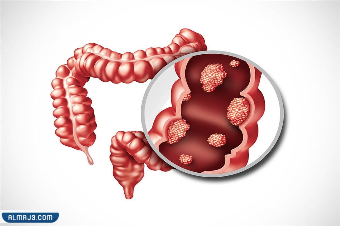 الفرق بين البواسير وسرطان المستقيم - تعريف سرطان المستقيم