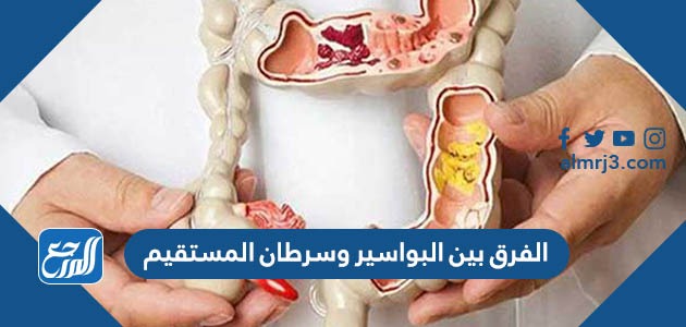 الفرق بين البواسير وسرطان المستقيم