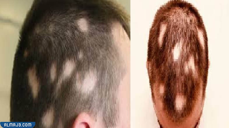 الفرق بين الثعلبة وفراغات الشعر من حيث العلاج