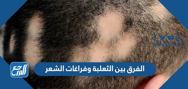 الفرق بين الثعلبة وفراغات الشعر