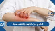 الفرق بين الجرب والحساسية