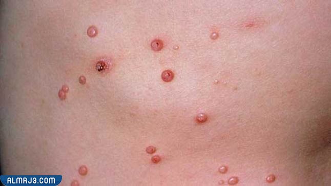 الفرق بين الجرب والحساسية في الشكل