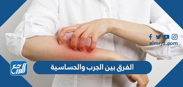 الفرق بين الجرب والحساسية