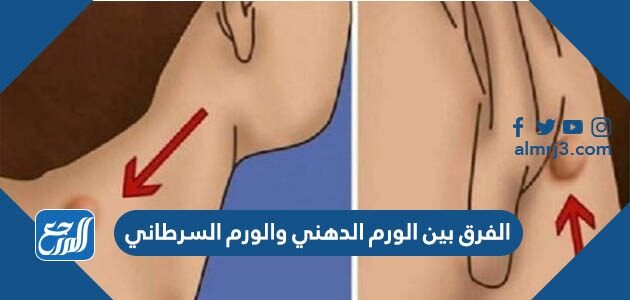 الفرق بين الورم الدهني والورم السرطاني