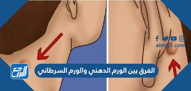 الفرق بين الورم الدهني والورم السرطاني