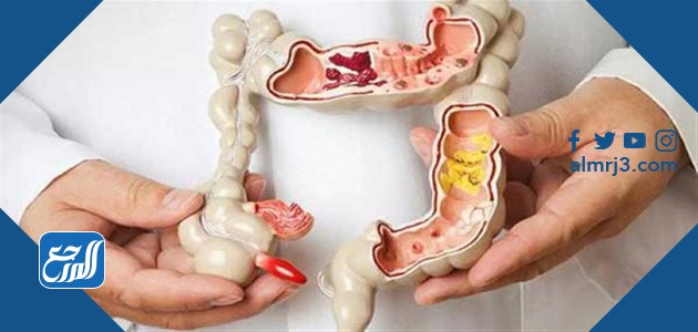 المخاط في البراز