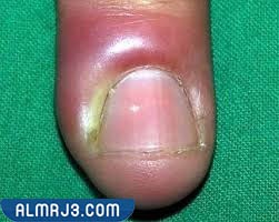 المرهم الاسود للاصبع المدوحس