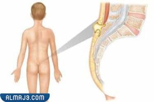 المرهم الاسود للبواسير والناسور العصعصي