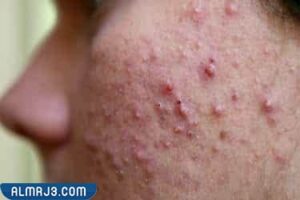 المرهم الاسود للحبوب