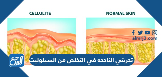 تجربتي الناجحه في التخلص من السيلوليت