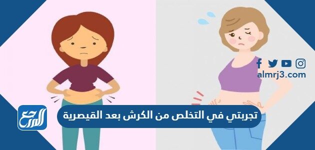 تجربتي في التخلص من الكرش بعد القيصرية