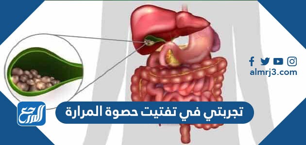 تجربتي في تفتيت حصوة المرارة