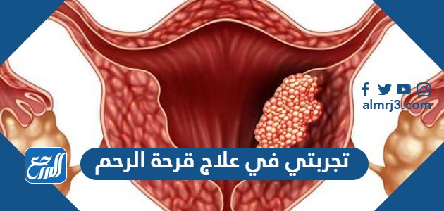 تجربتي في علاج قرحة الرحم