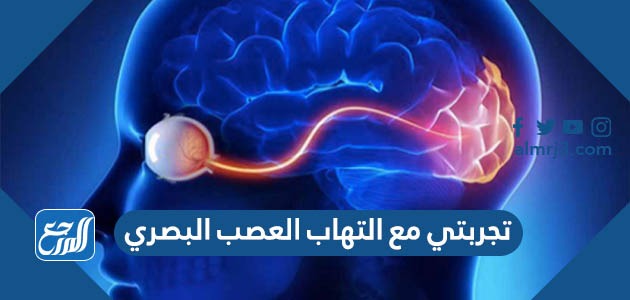تجربتي مع التهاب العصب البصري