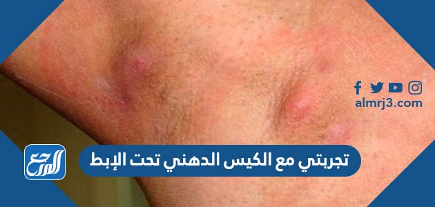 تجربتي مع الكيس الدهني تحت الإبط