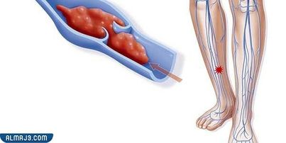 تجربتي مع جلطة الساق