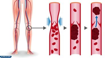 تجربتي مع جلطة الساق