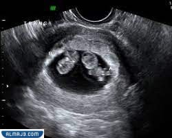 تشخيص الحمل بتوأم بكيس واحد