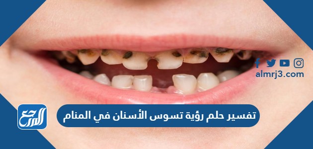 تفسير حلم رؤية تسوس الأسنان في المنام