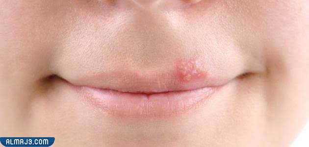تنبيهات بشأن التعامل مع مرض الهربس الفموي