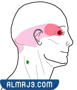 حالات-الصداع-التي-تستدعي-استشارة-الطبيب